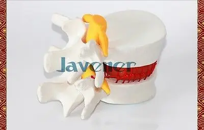 

Human Anatomical Lumbar Vertebra Slipped Disc Medical Model