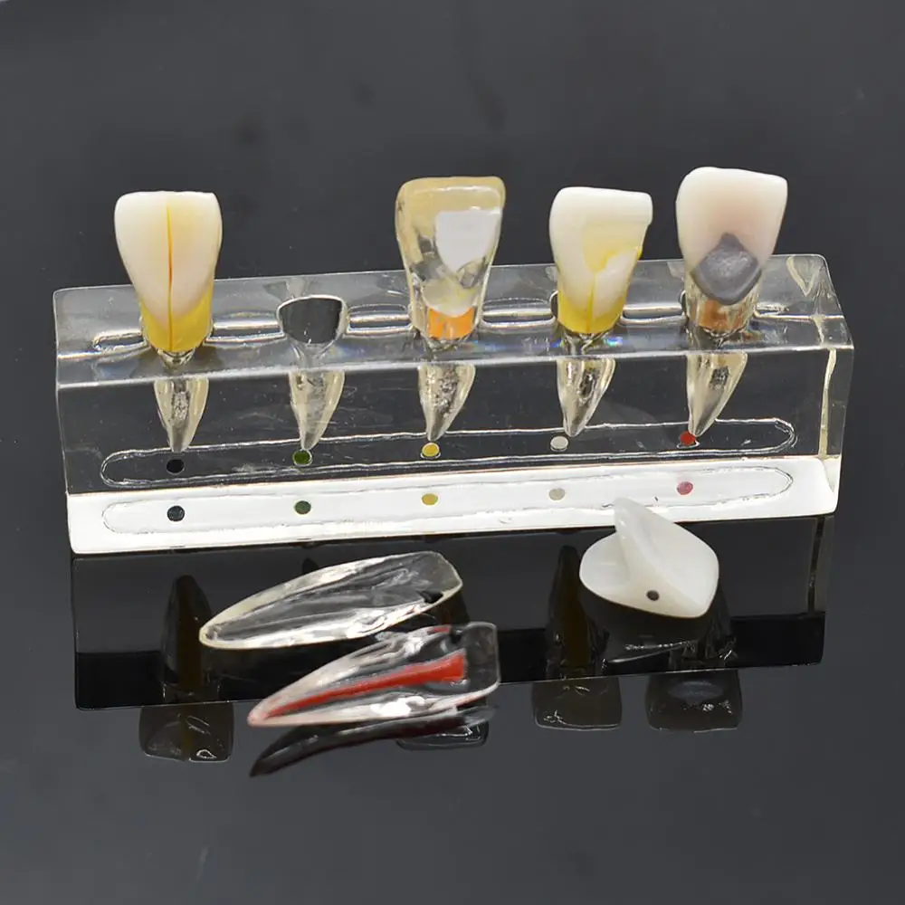 

Dental endodontic pathological anterior front labial teeth model dental lab dentistry endo model