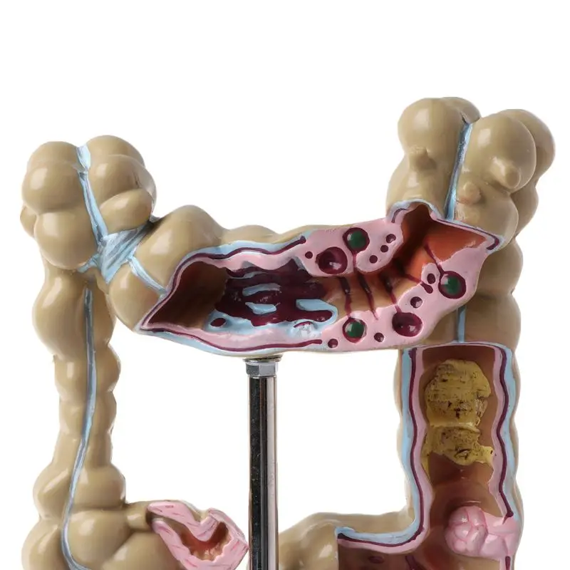 Human Colorectal Lesion Model Pathological Anatomy Colon Diseases Intestine Medical Teaching Learning Tool