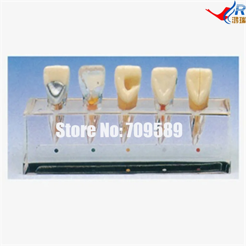 Clinical Model of Endodontics, Dental Care Model