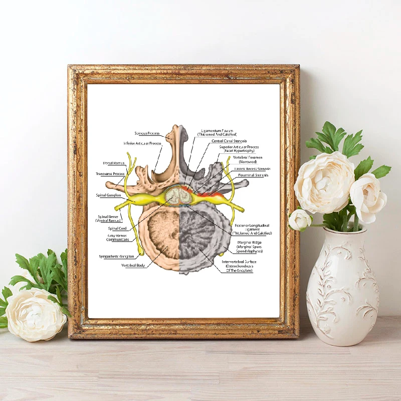 Human Nervous System Prints Osteoarthritis Poster Medicine Educational Chart Orthopedics Office Wall Art Decor Canvas Painting