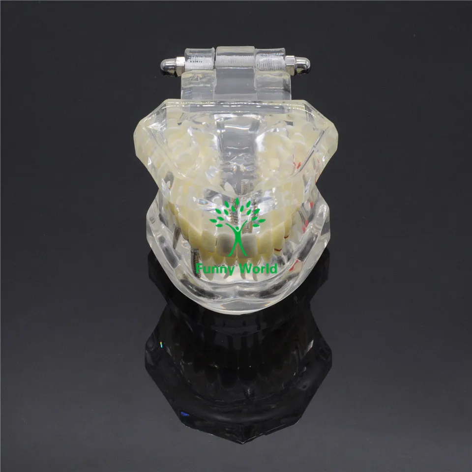 New Dental Implant Disease Tooth Pathological Extrusion Missing Teeth Model In a Box