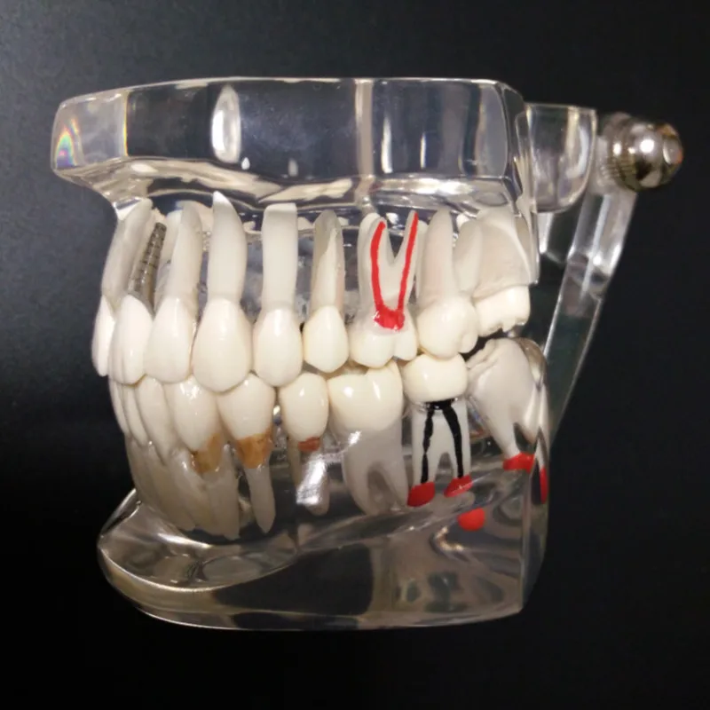 

Clear Transparent Dental Implant Disease Caries Teeth Model With Restoration For Doctor Dentist Patient Communication