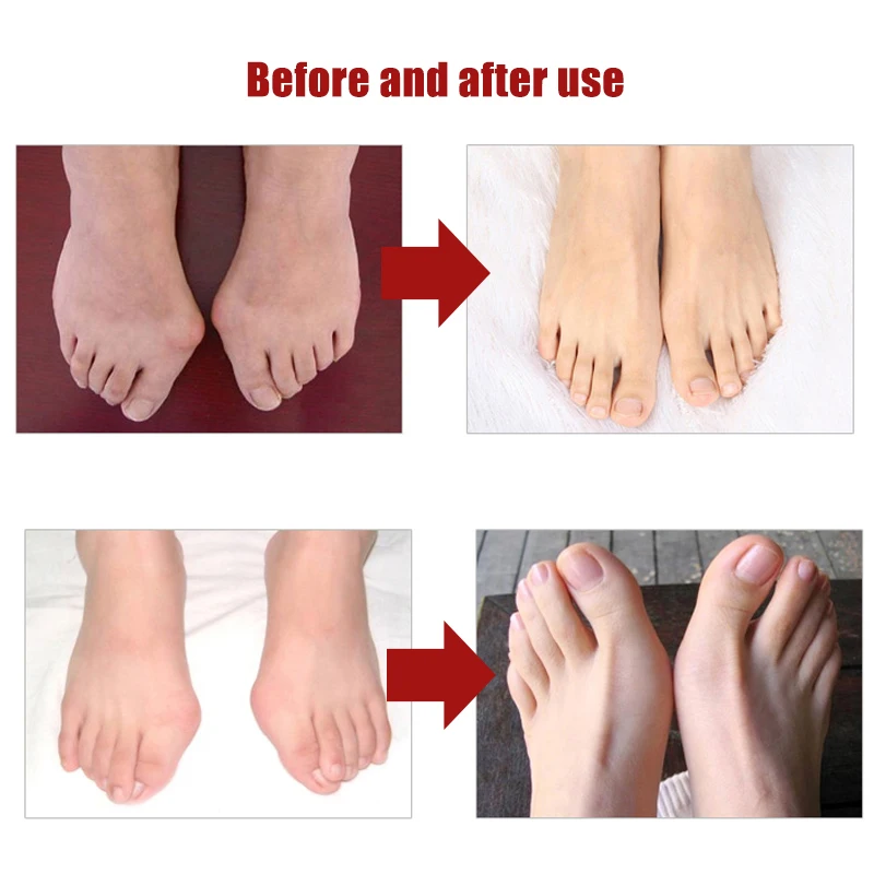 Corrector Hallux Valgus, triturador de escarabajos, electrodoméstico exterior, tecnología profesional, productos para el cuidado de la salud