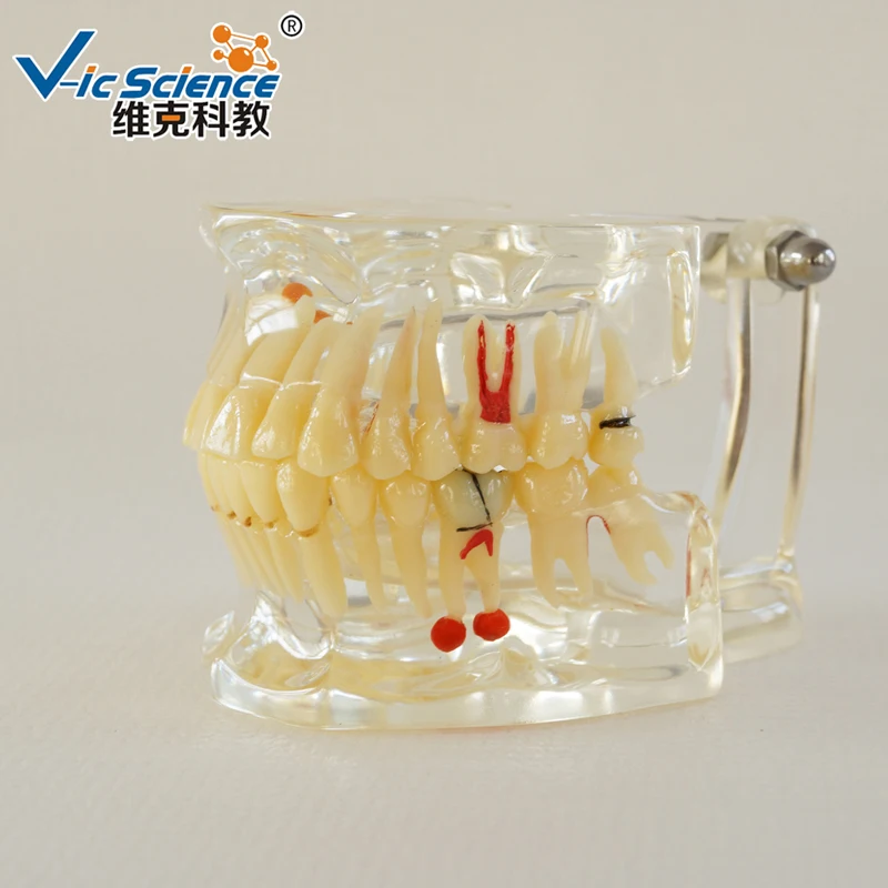 Dental Zahn Modell/Pathologischen Zähne Modell Mit Fehlende Zahn Modell, Typodont Modell