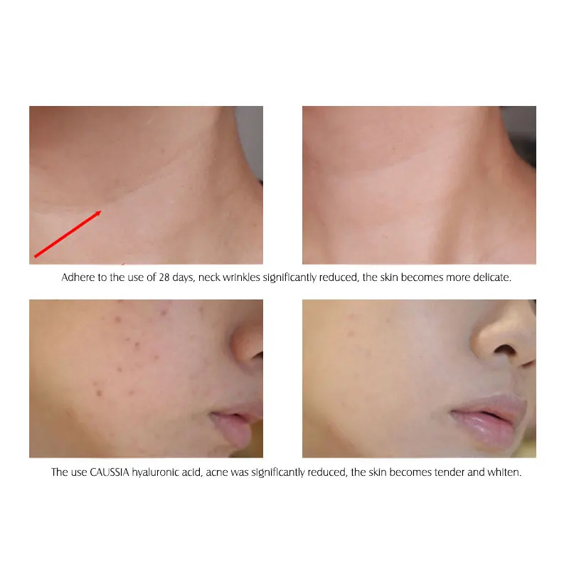 أرتيكاكار-سيروم حمض الهيالورونيك للوجه ، ترطيب وترطيب ، جوهر العناية بالبشرة ، عناية بالوجه ، 10 في الكثير #4