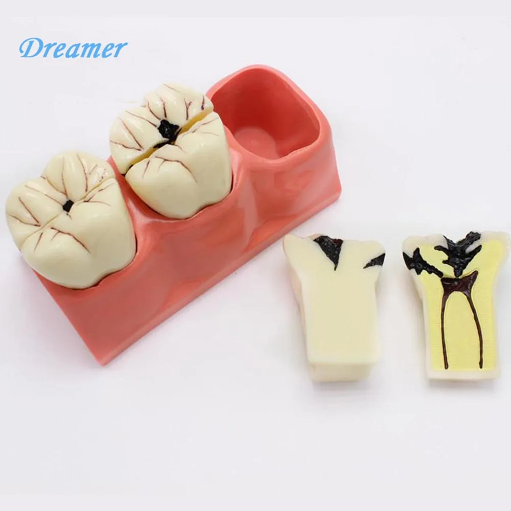 

Dissected Model of Dental Caries,Caries Decomposition Model Oral Dental Tooth Model Teeth Whitening