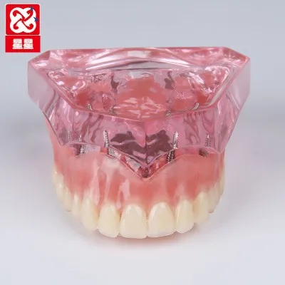 Implant repair model Oral cavity model Dental restoration free shipping