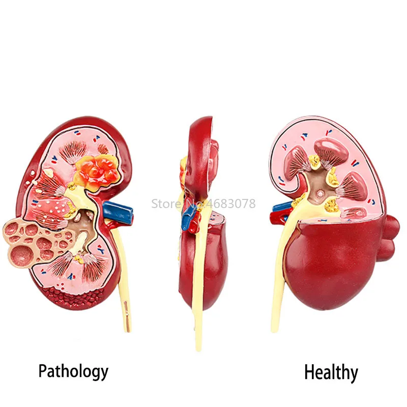 Human Body Organ Medical Kidney Anatomical Model Diseased Kidney  Model Human Anatomy Teaching Supplies