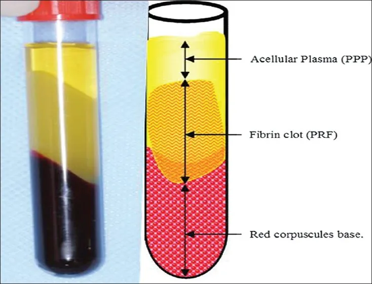 50pcs 10ml PRF tube Platelet rich Fibrin, 10ml Blood PRF tube for detistry, Maxillofacial surgery, orthopedics, plastic surgery