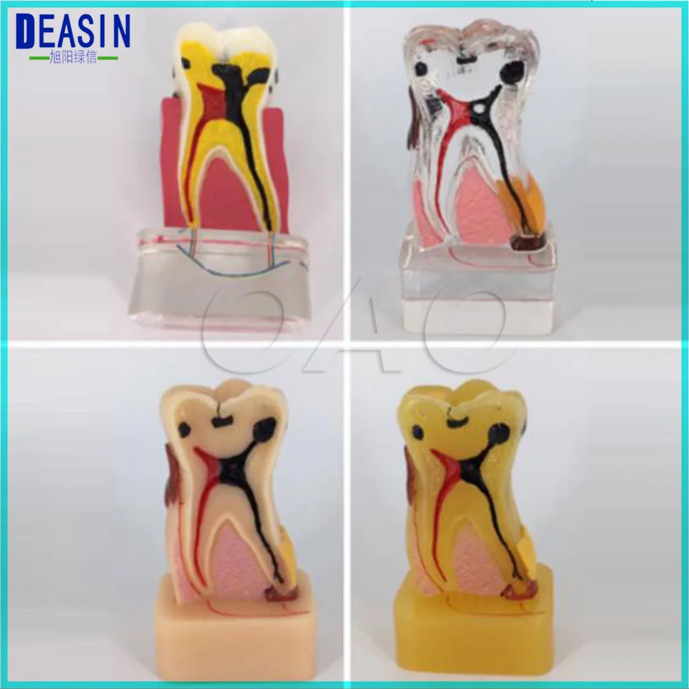 

Teeth Disease Model 4:1 Dentist Dental Study Teach Tooth Model