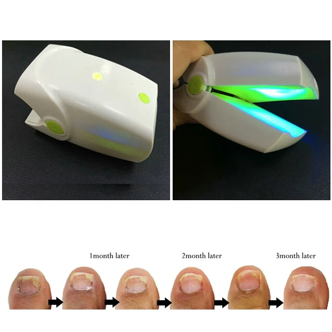 Hot Selling Painless Nail Fungus Laser Device With 905nm Laser For Nail Fungus Treatment, Laser For Onychomycosis