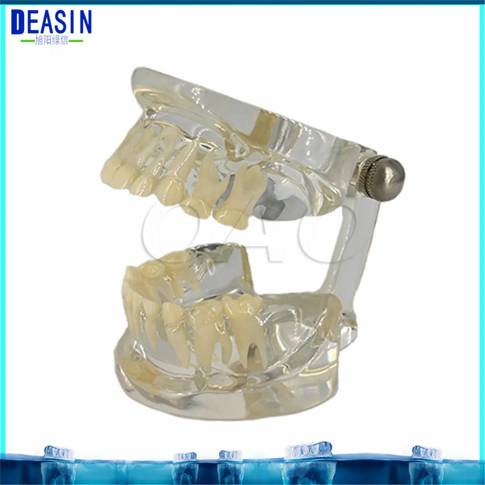 2018 DEASIN Dental Implant Disease Teaching Teeth Model & Restoration Bridge Tooth