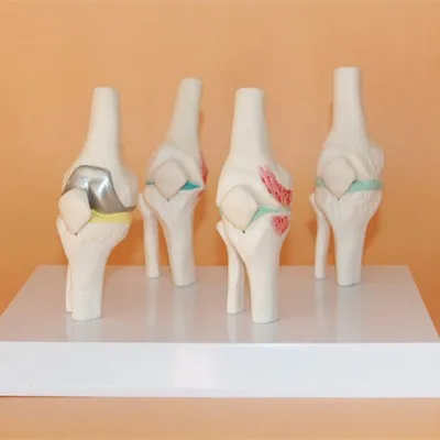 

Knee Disease model Orthopedics teaching Medical teaching model free shipping