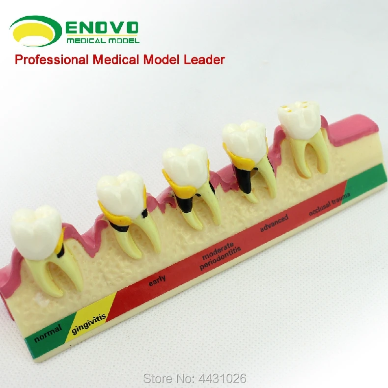 

Enovo Oral Periodontal Disease Classification Model Gingivitis Degree Chronic Periodontitis Dentist Communication