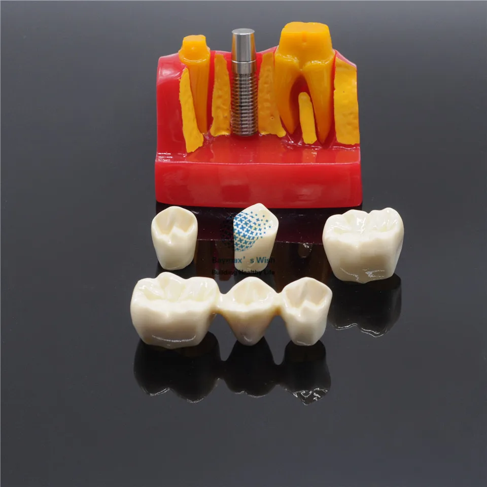 Dental Lab Implant Analysis Crown Bridge Demonstration Teeth Model 1SET