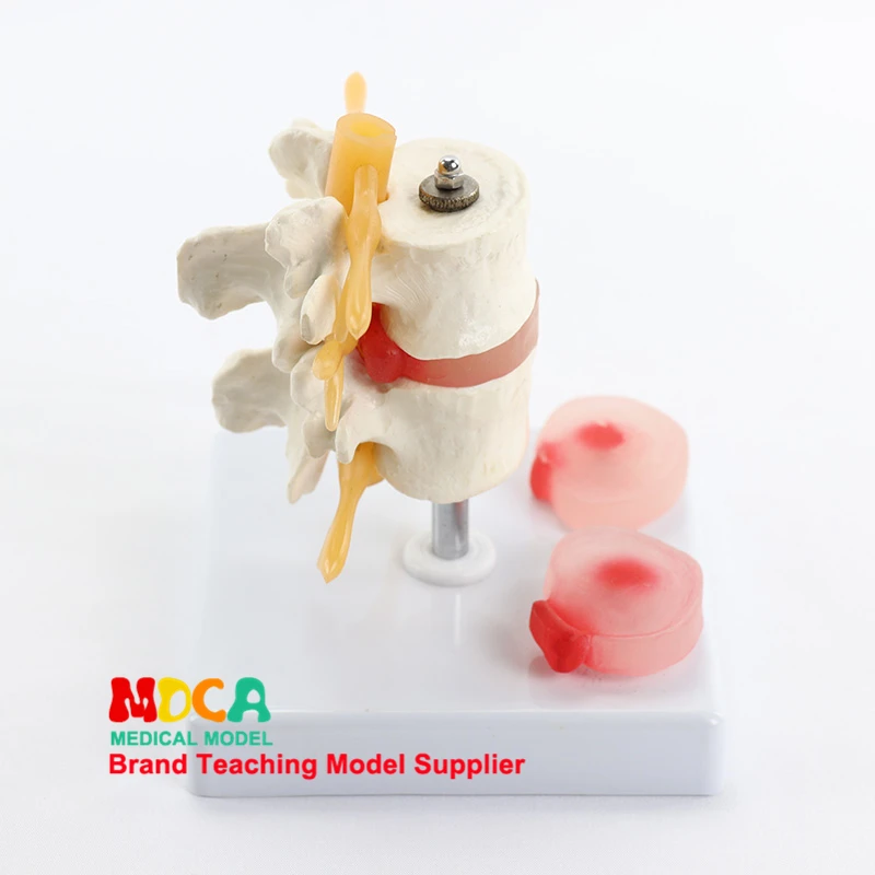 Lesioni lombari Dis intervertebrale umano.