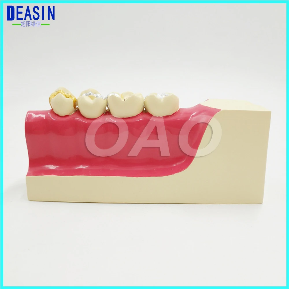 Doctor - patient communication model with magnetic Dental teeth model Lower right posterior teeth tissue decomposition model