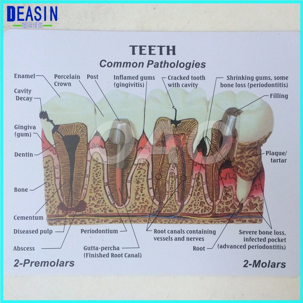 

High Quality Dentistry Rich Details Teaching Aids Caries Tooth Model Dentist Patient Communication Anatomy Model Equipment