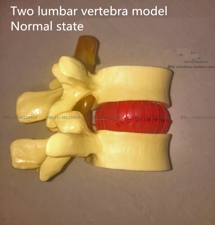 medical Lumbar vertebra lesion model Normal state CMAM VERTEBRA12 Life-size Lumbar Vertebrae Models in 3 Stages of Degeneration