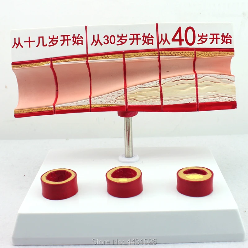 

ENOVO The model of blood lipid cholesterol and age model coronary thrombosis