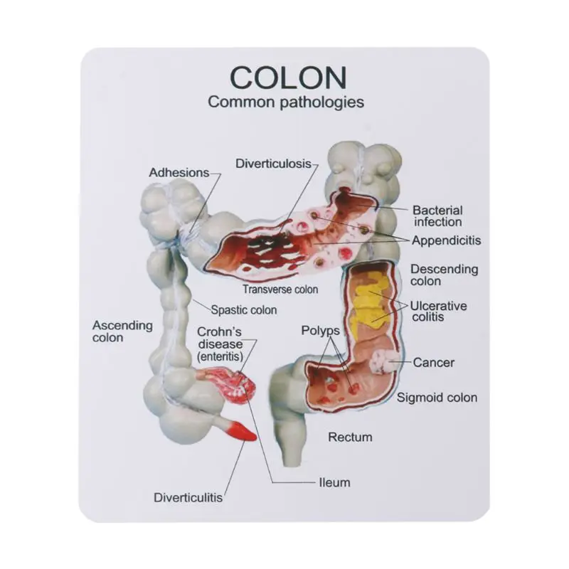 Human Colorectal Lesion Model Pathological Anatomy Colon Diseases Intestine Medical Teaching Learning Tool