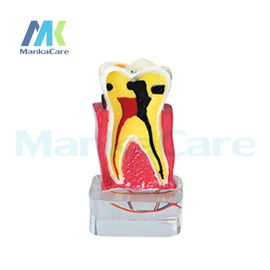 

Manka Care - 4 Times periodontal with Nerve/Made of imported resin Oral Model Teeth Tooth Model