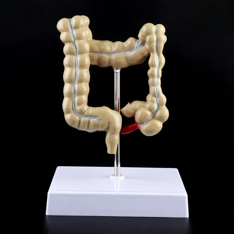 Human Colorectal Lesion Model Pathological Anatomy Colon Diseases Intestine Medical Teaching Learning Tool