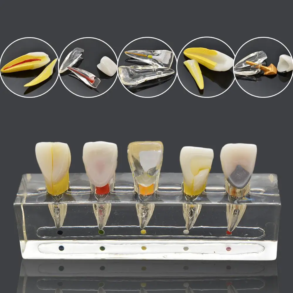 Dental endodontic pathological anterior front labial teeth model dental lab dentistry endo model