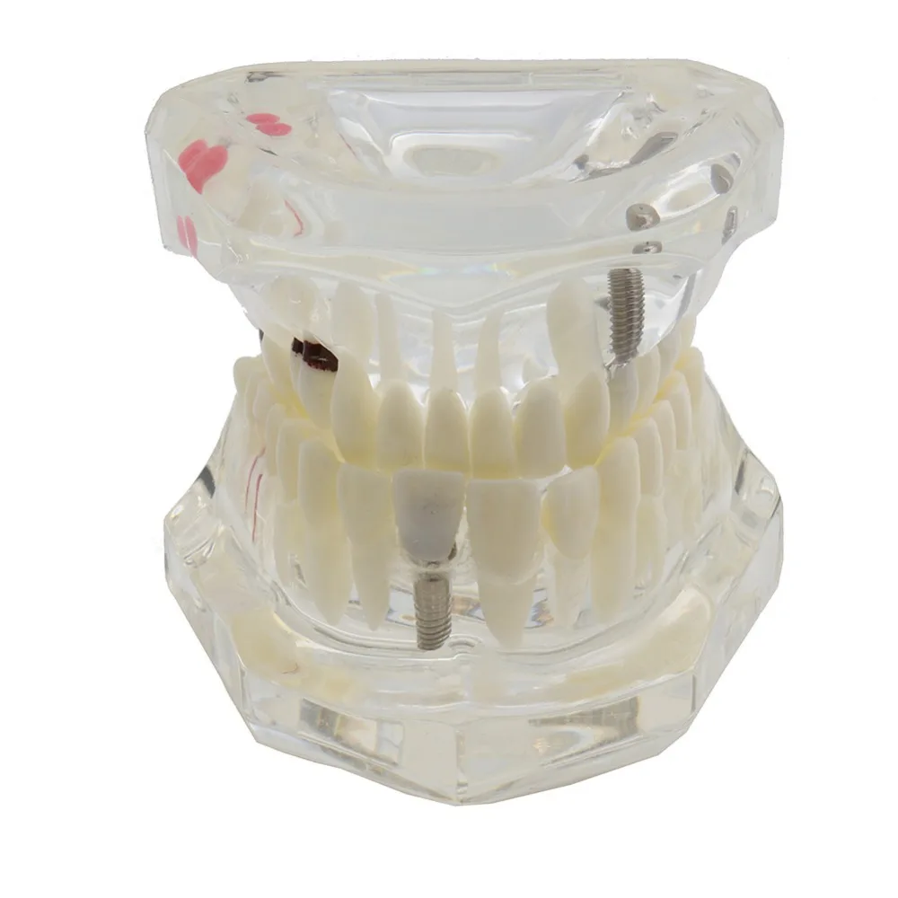 

Dental Teeth Model Implant and Restoration Model Transparent Study Analysis Demonstration Teeth Model With Restoration Bridge