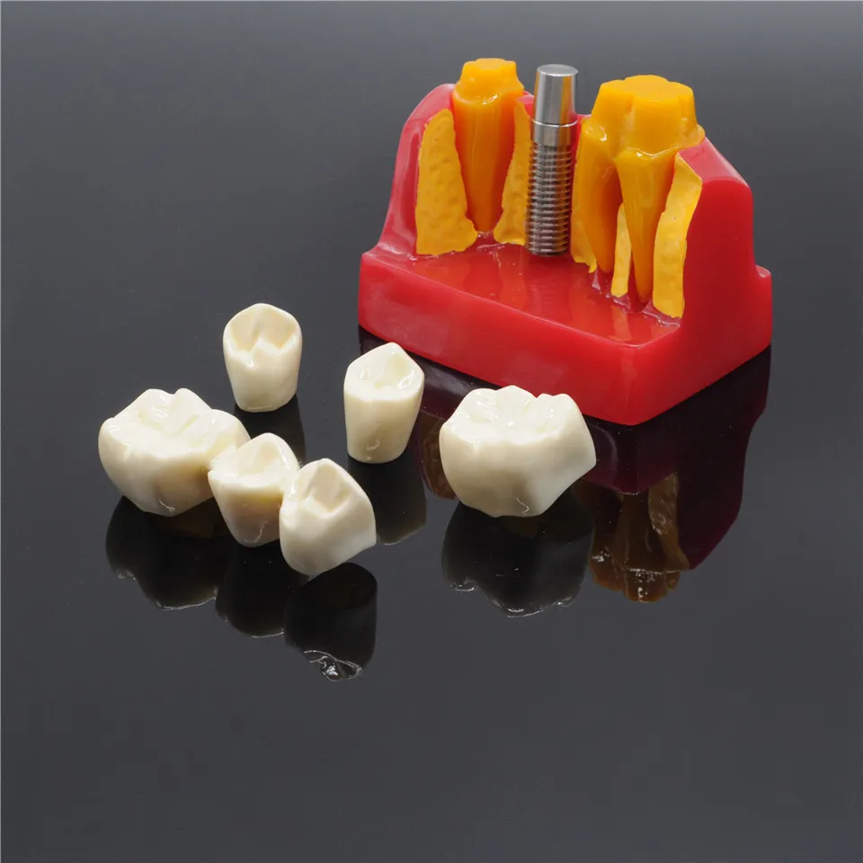 Dental Clinic Implant Analysis Crown Bridge Demonstration Teeth Model