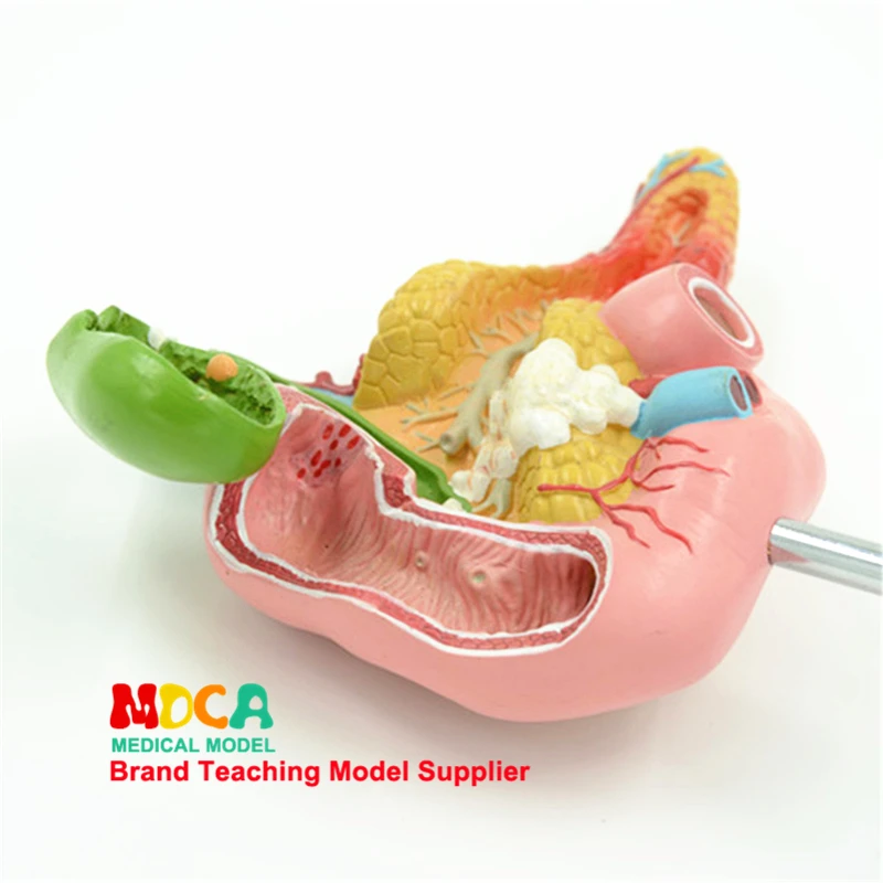 Diseased Pancreas Spleen Hepatobiliary Duodenum Model Human Pathological Anatomy Teaching Model