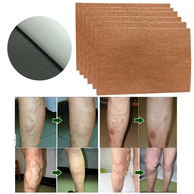 

9 Pcs Spider Veins Varicose Treatment Plaster Varicose Veins Cure Patch Vasculitis Natural Solution Herbal Patches