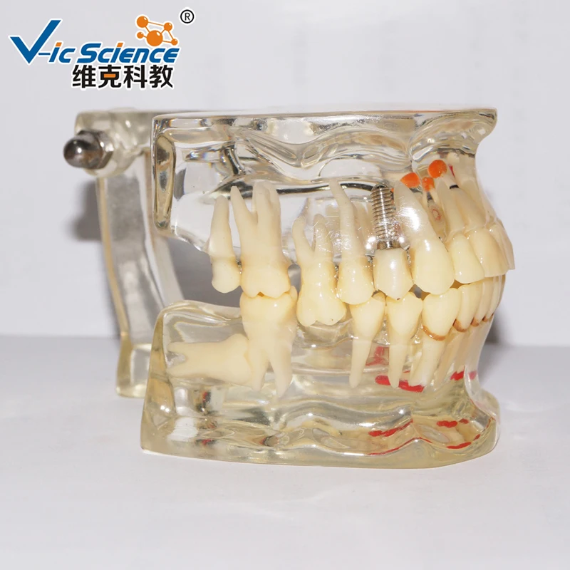 Dental Zahn Modell/Pathologischen Zähne Modell Mit Fehlende Zahn Modell, Typodont Modell