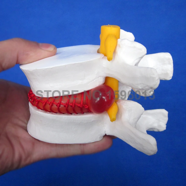 medical Lumbar vertebra lesion model Normal state CMAM VERTEBRA12 Life-size Lumbar Vertebrae Models in 3 Stages of Degeneration