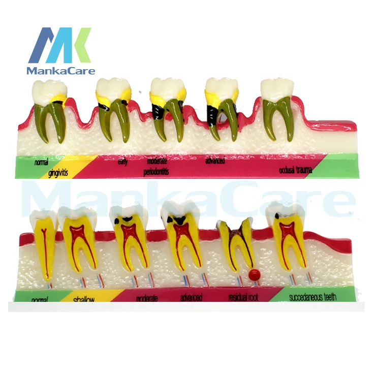 

Dental Model Periodontal Disease Assort Tooth Typodont Teach Model 2 type dental teeth model