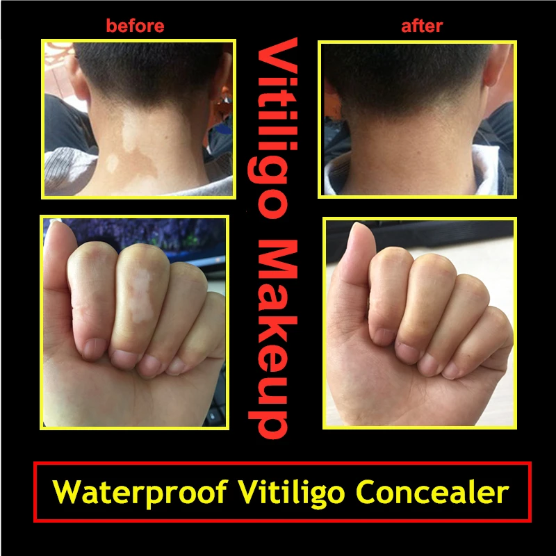 Cover Vitiligo Patches Waterproof Instant Skin Makeup Coating Concealer Pen on Face Body for Women Men Kids by XISHENGYAN 5pc