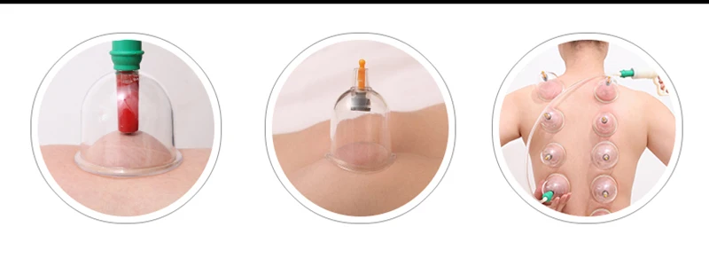 Vacuum cupping apparatus for home use  Suction cupping  Invigorate the circulation of blood