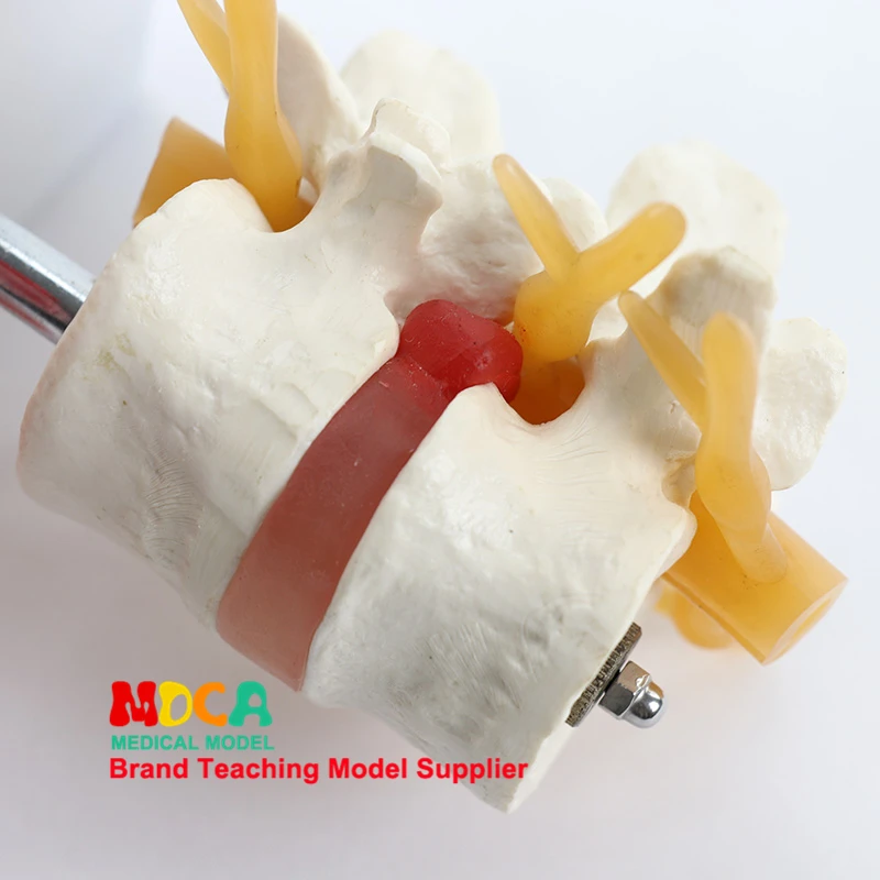 Lesioni lombari Dis intervertebrale umano.