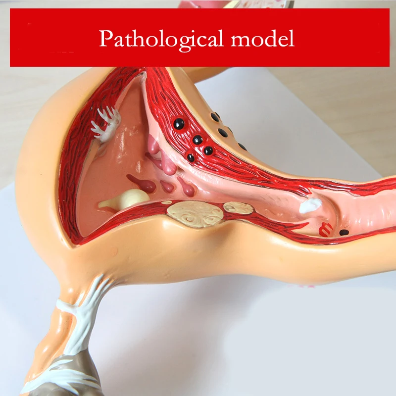 Ciencia médica, útero Normal/patológico, ovario, modelo anatómico, sección transversal de anatomía, suministros de enseñanza médica