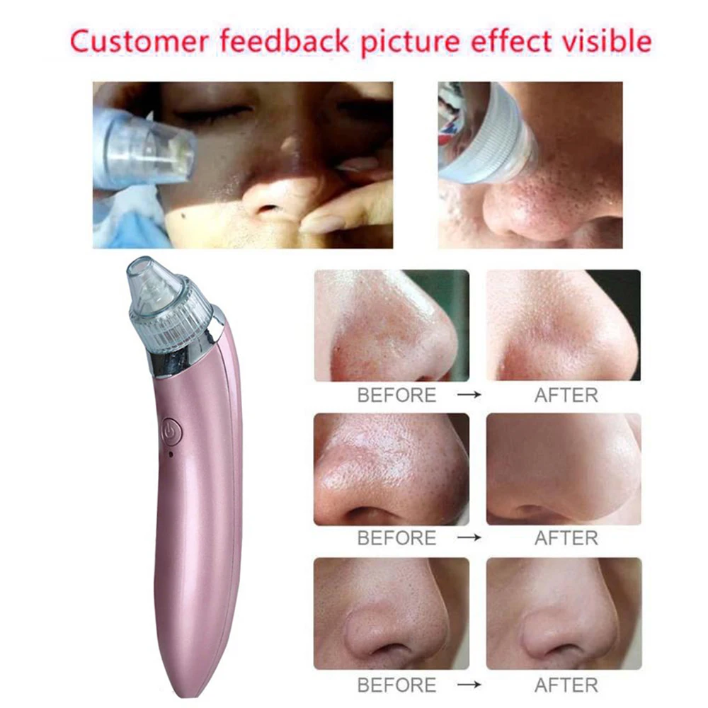 Blackhead Remover Face Deep Nose Cleaner T Zone Pore Acne Nose  Skin Set Beauty Skin Care Tools