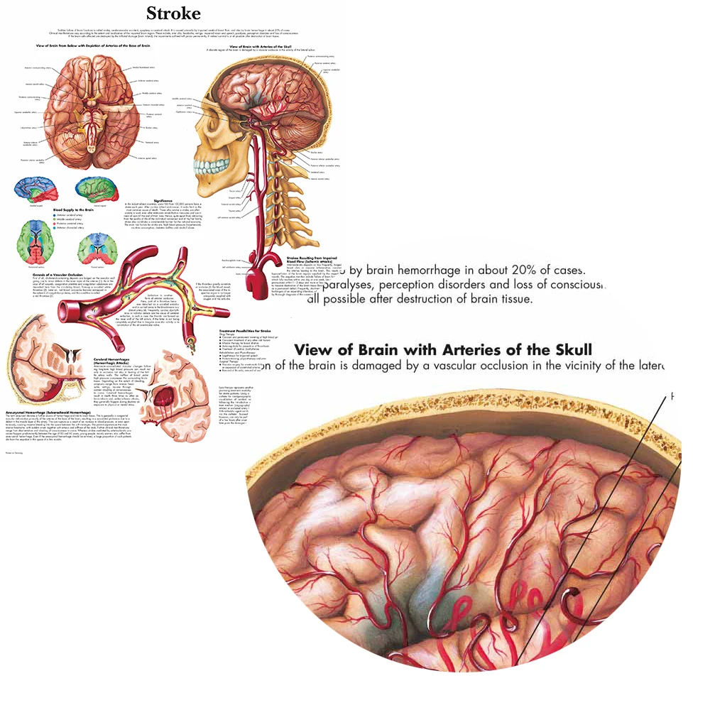 Anatomy of Brain in Stroke Anatomical Chart Neurological Posters Pathology Canvas Wall Pictures for Medical Education Home Decor