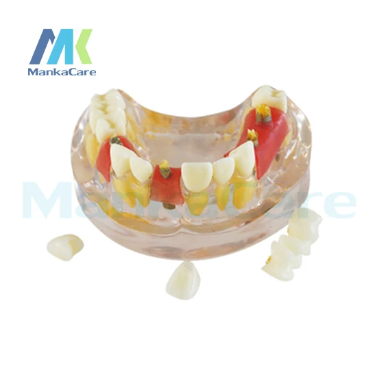 

Manka Care - Transparent model shows normal root, implant in the mouth Oral Model Teeth Tooth Model