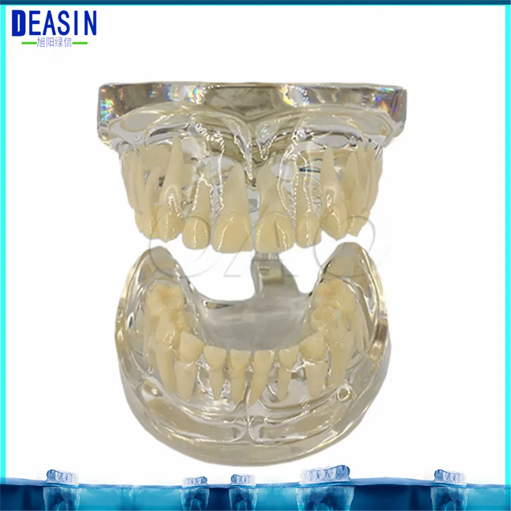 2018 DEASIN Dental Implant Disease Teaching Teeth Model & Restoration Bridge Tooth