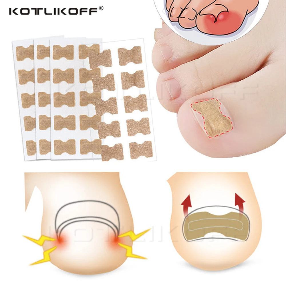 

KOTLIKOFF Toenail Correction Stickers Ingrown Toenail Stickers Paronychia Treatment Pedicure Toe Nail Care Corrector Patch