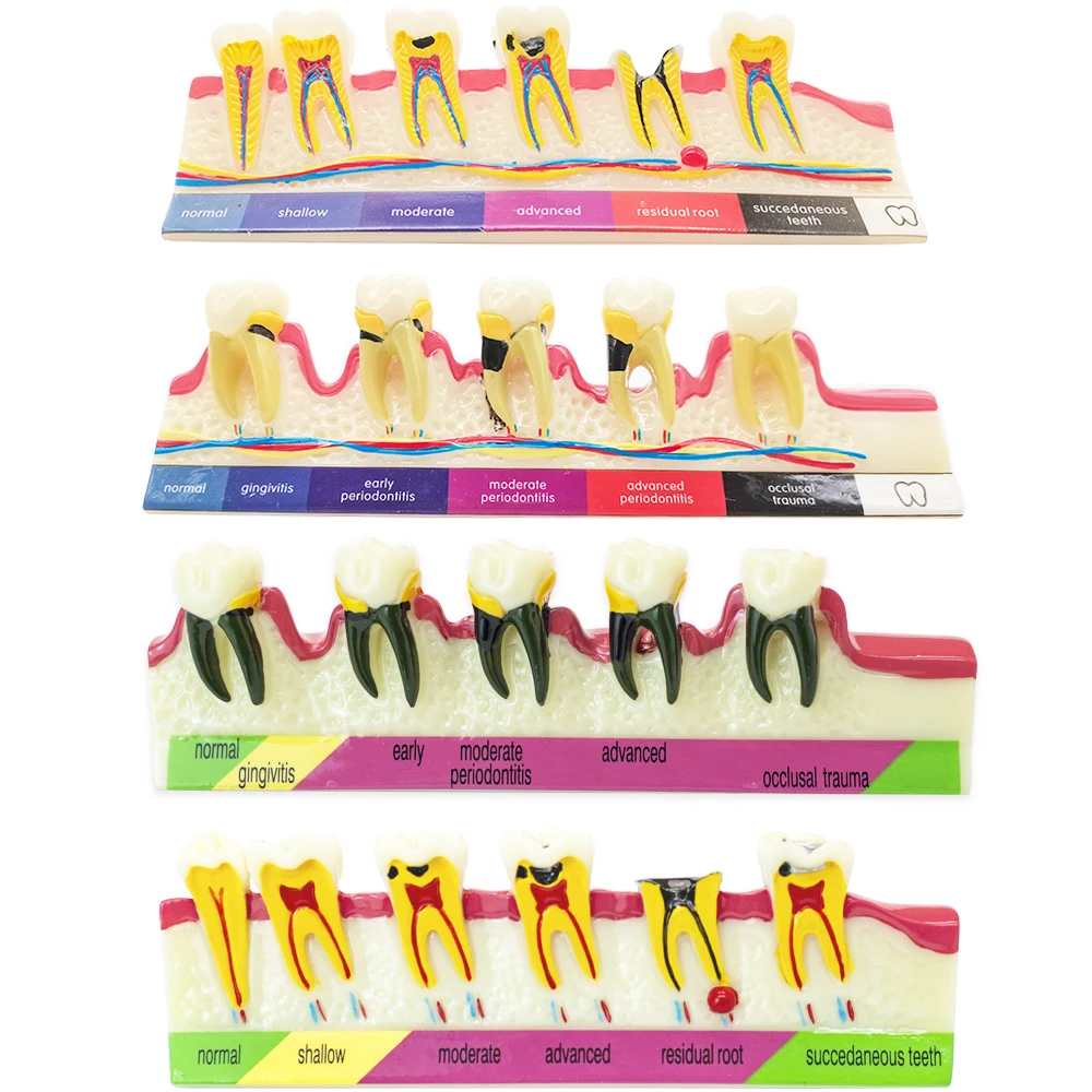 Teeth Periodontal Disease Model Dental Caries breakdown display Periodontitis show Teaching Tooth Model Dentist Communication