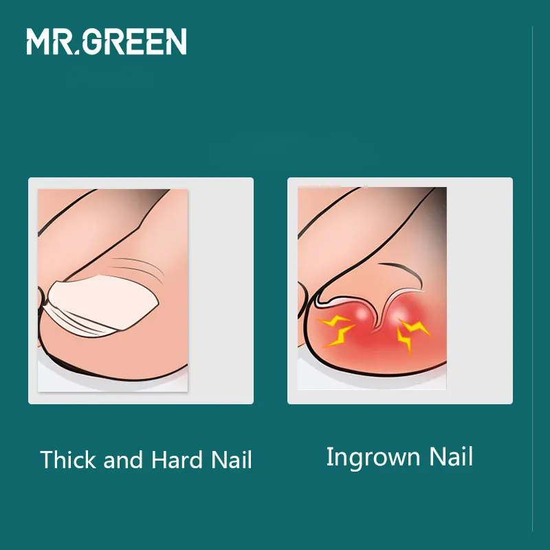 MR.สีเขียวเล็บเครื่องมือสแตนเลสสตีลหนา Toenails คุด Cuticle Nipper Trimmer Plier กรรไกรเล็บ Clippers