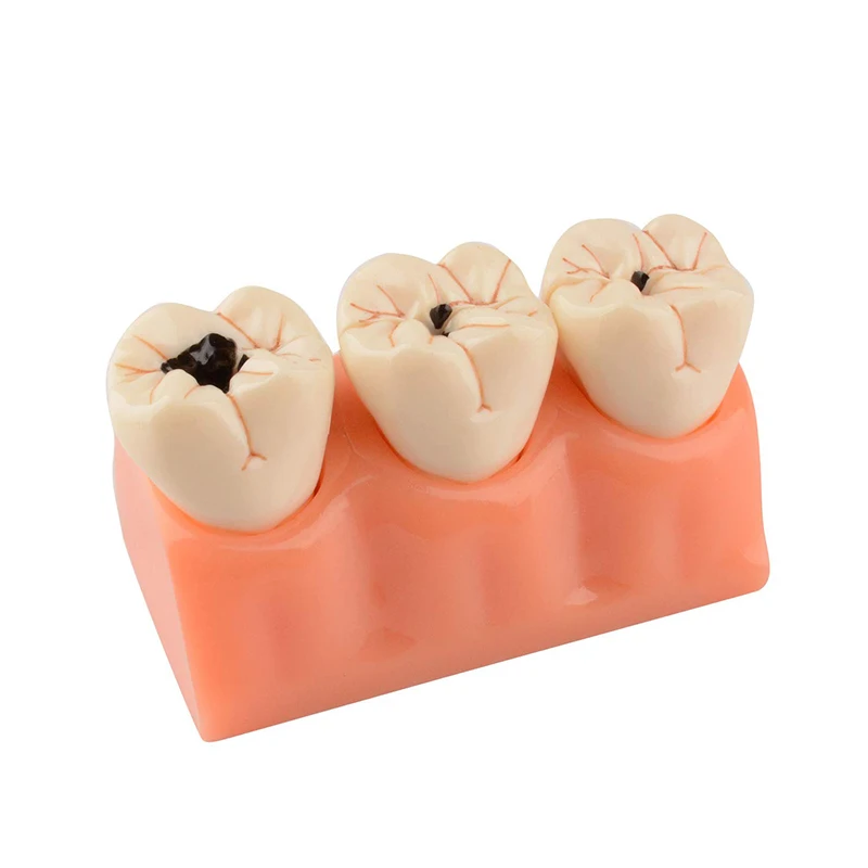 

Dental Decayed Teeth Model Denture Caries Disease Tooth Model Decomposition Decay Tooth Model Dentist Teaching Tools