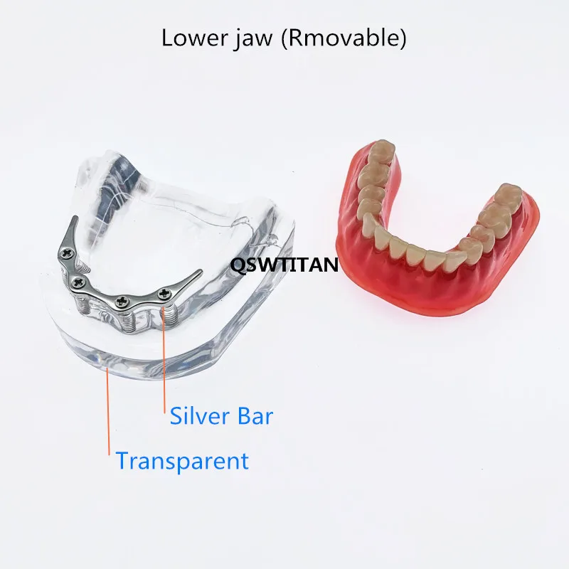 Dental Overdenture Superior With Implants Demo Model Teeth Model For Student Dentists