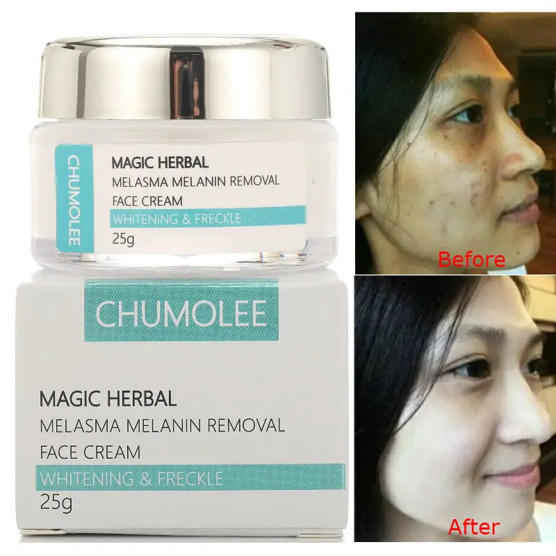 CHUMOLEE Strong Whitening Cream Remove Melasma Freckle Acne Dark Pigment Spots Melanin Pimple Brightening Face Cream Skin Care